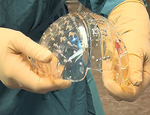 Implantan un cráneo de plástico hecho con una impresora 3D